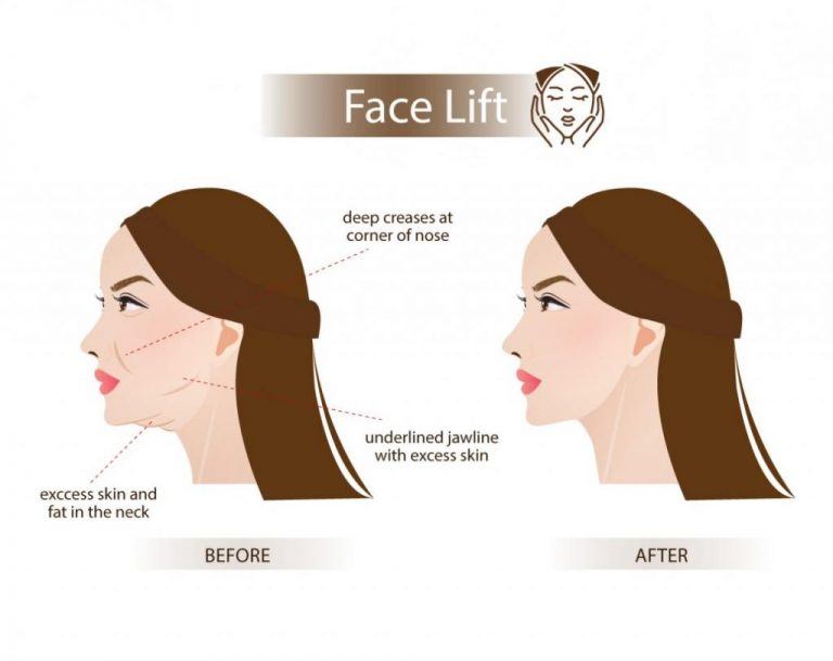 Face Lift