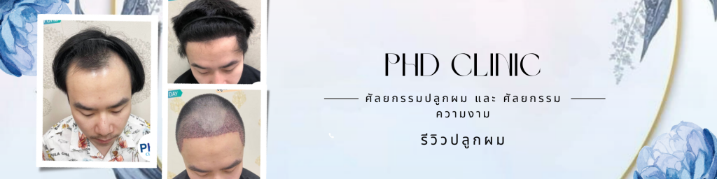 รีวิวปลูกผม