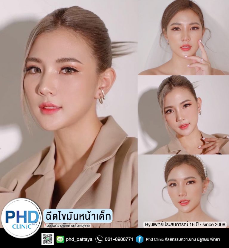 ฉีดไขมันหน้าพัทยา