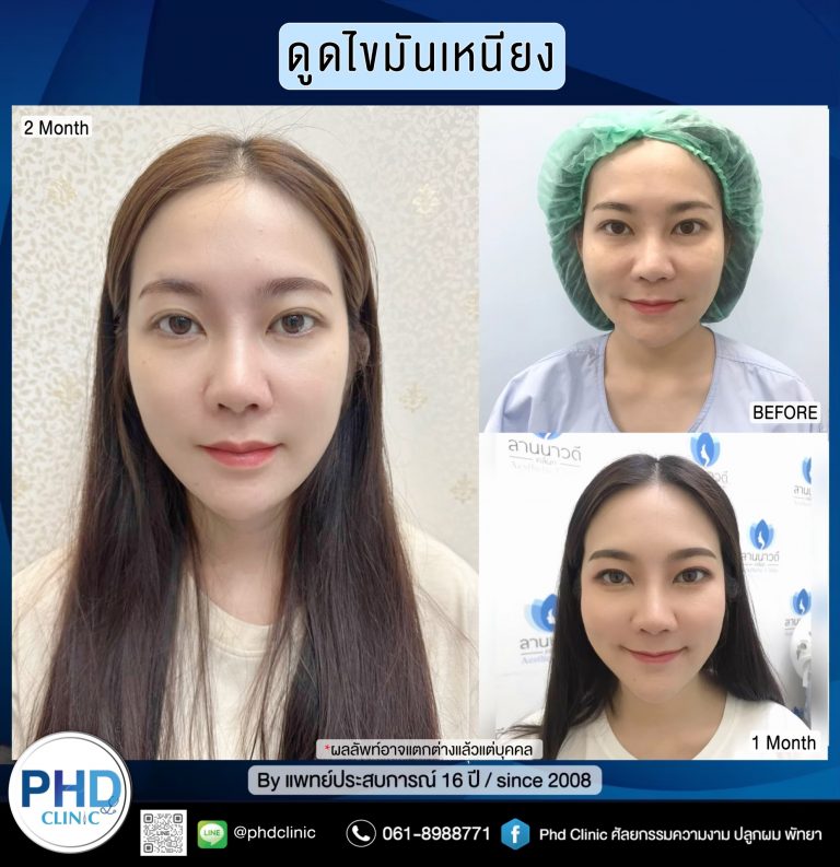 ดูดไขมันเหนียง พัทยา