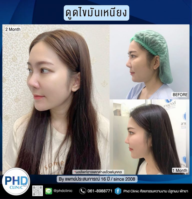 ดูดไขมันเหนียง พัทยา