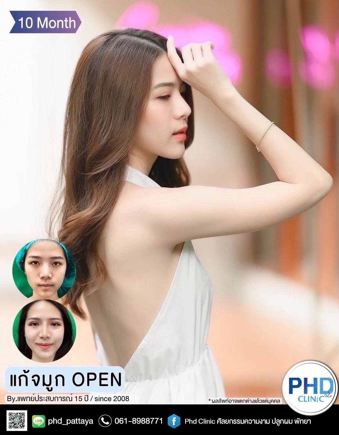 Revision Rhinoplasty Pattaya