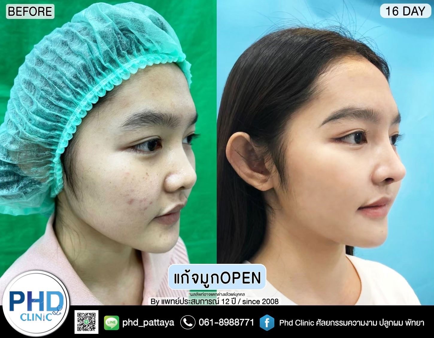 Revision Rhinoplasty Pattaya