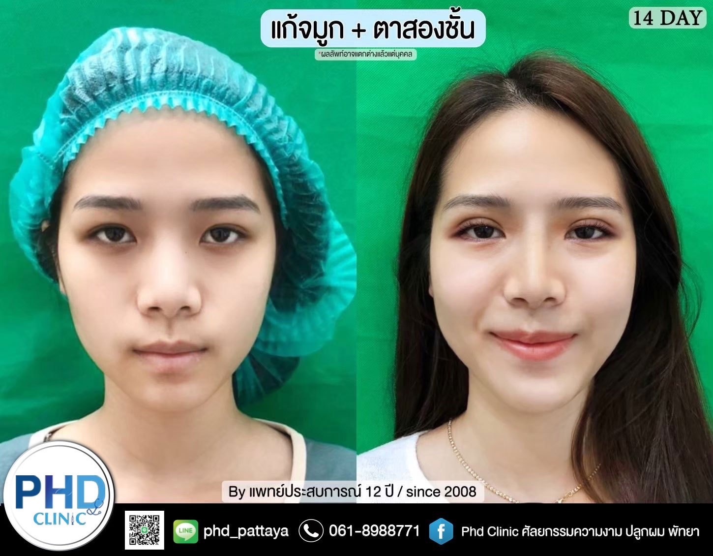 Revision Rhinoplasty Pattaya