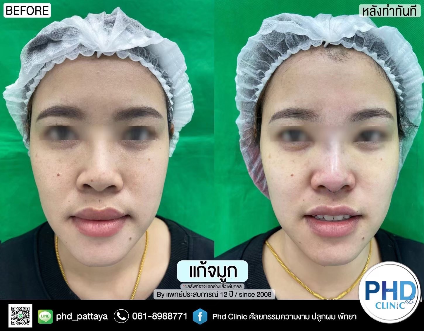 Revision Rhinoplasty Pattaya