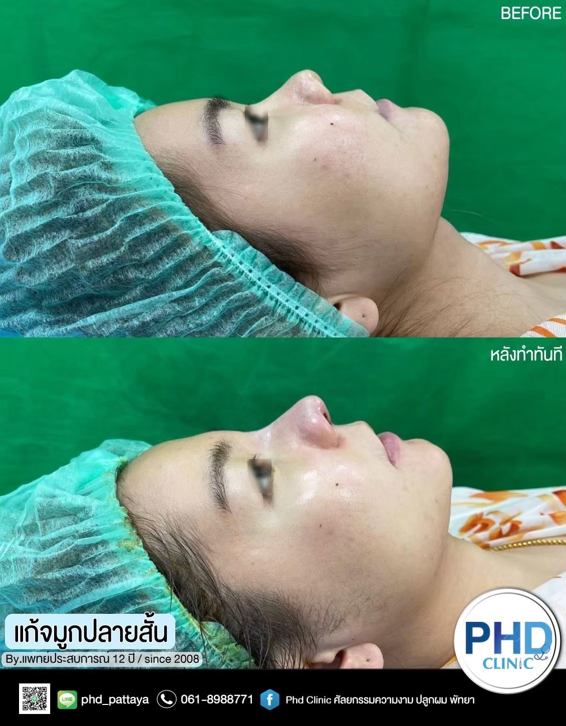 Revision Rhinoplasty Pattaya