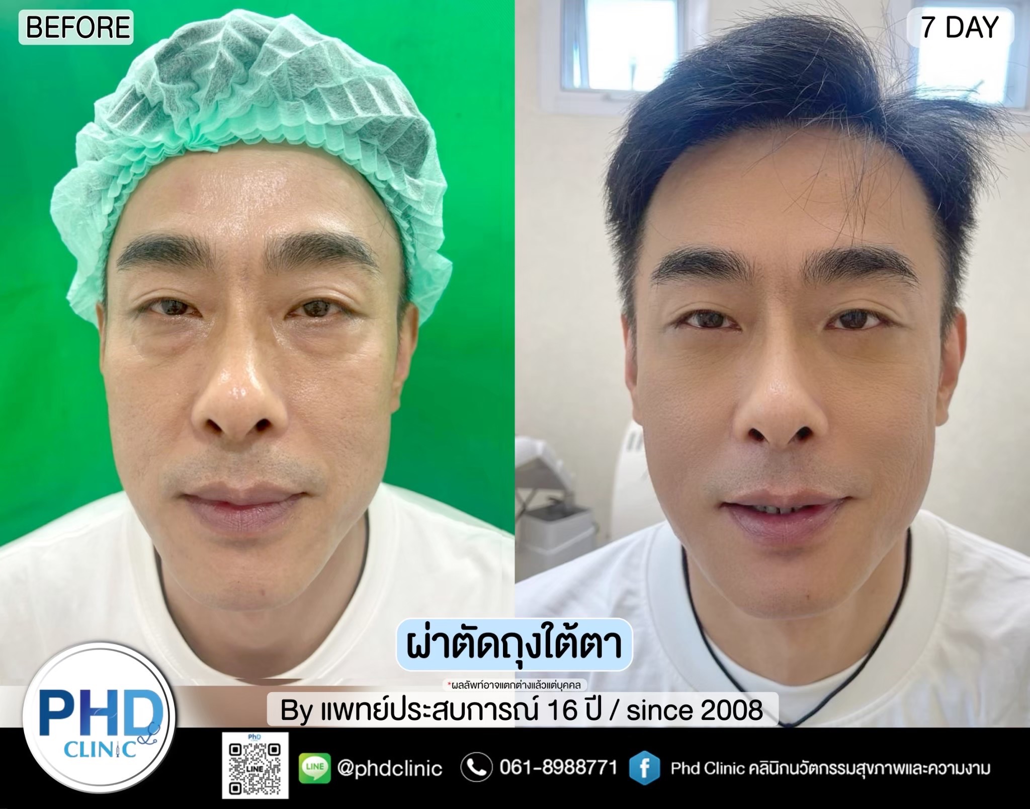 Lower Blepharoplasty