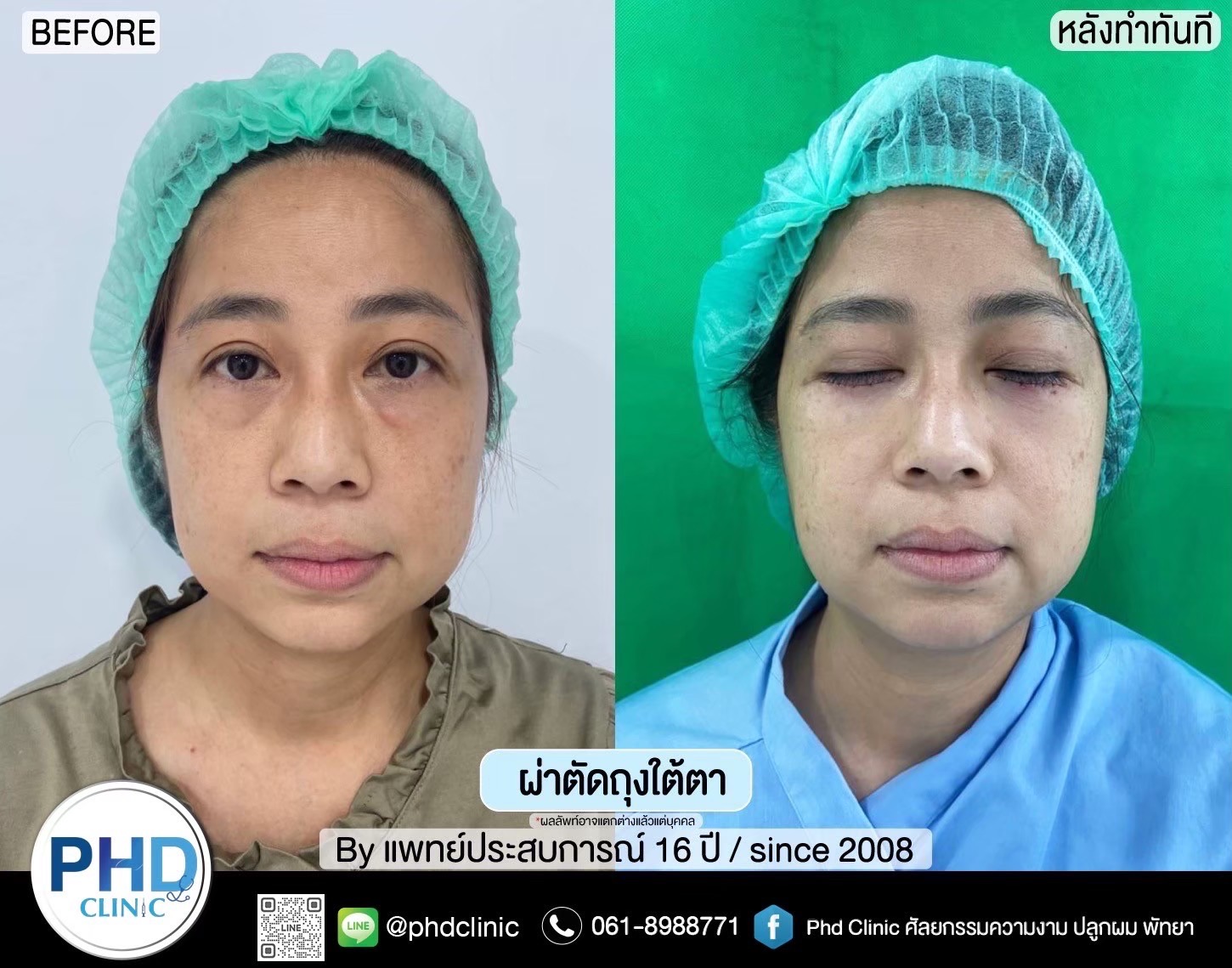 Lower Blepharoplasty