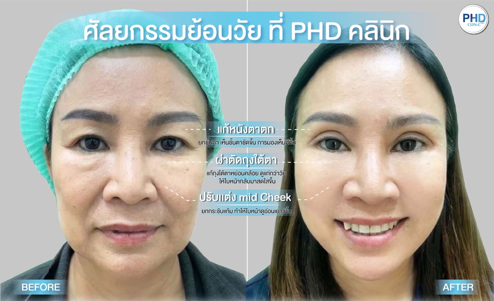 Lower Blepharoplasty