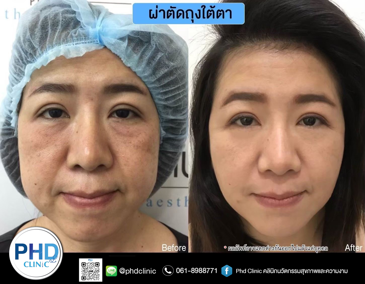 Lower Blepharoplasty