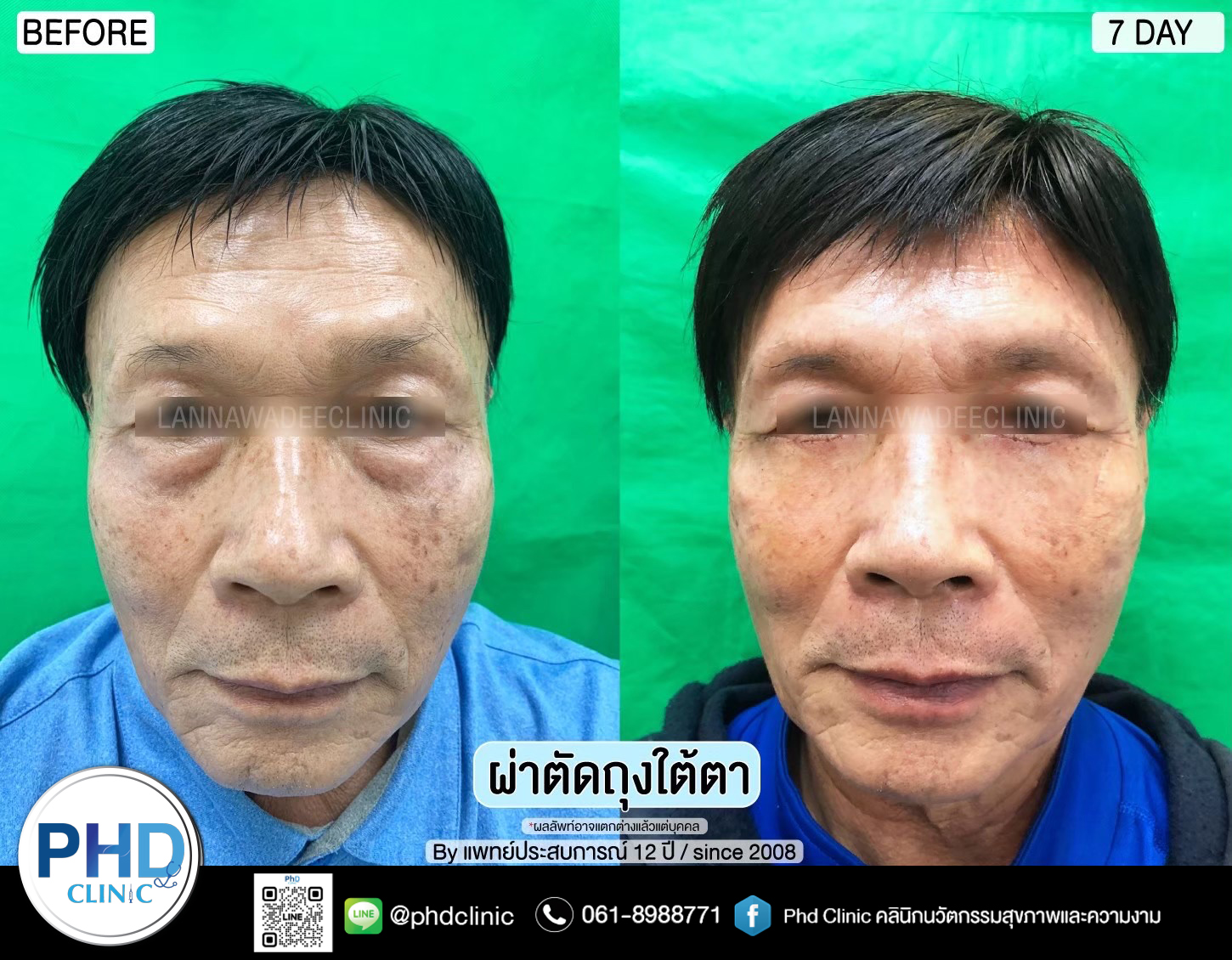 Lower Blepharoplasty