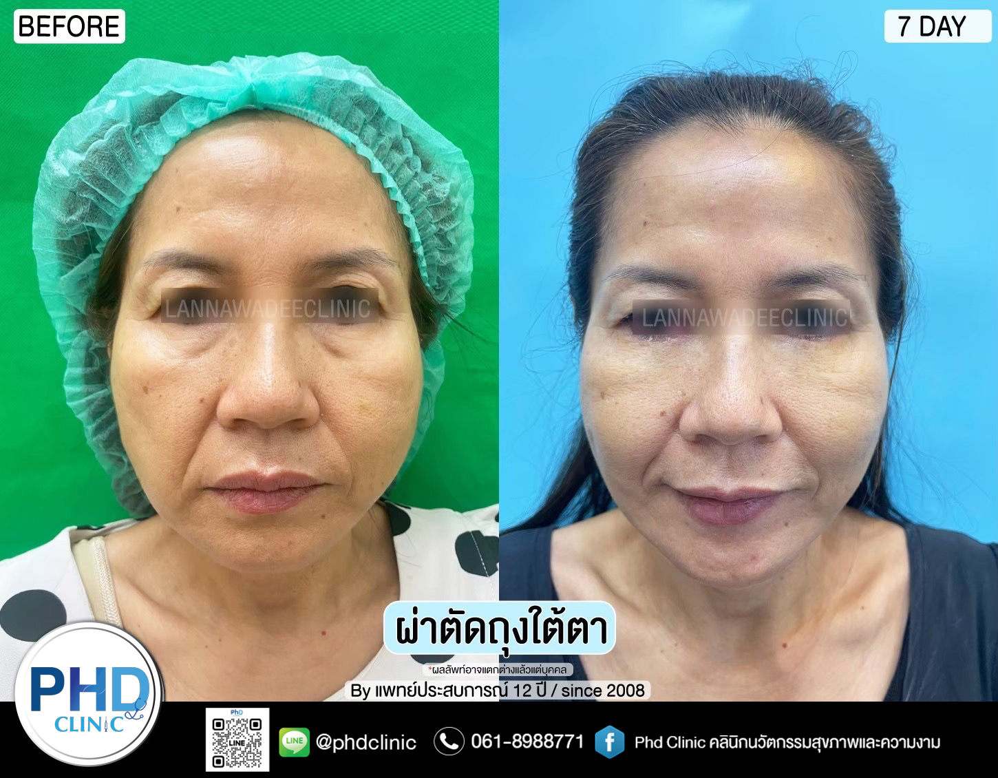 Lower Blepharoplasty