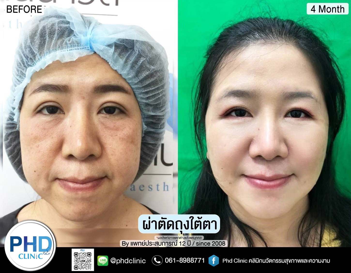 Lower Blepharoplasty