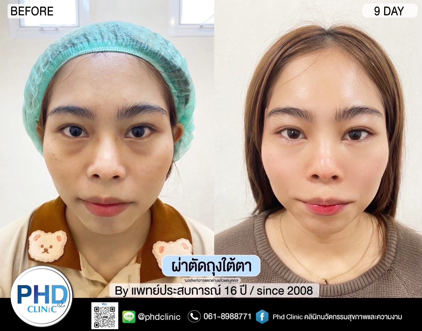 Lower Blepharoplasty
