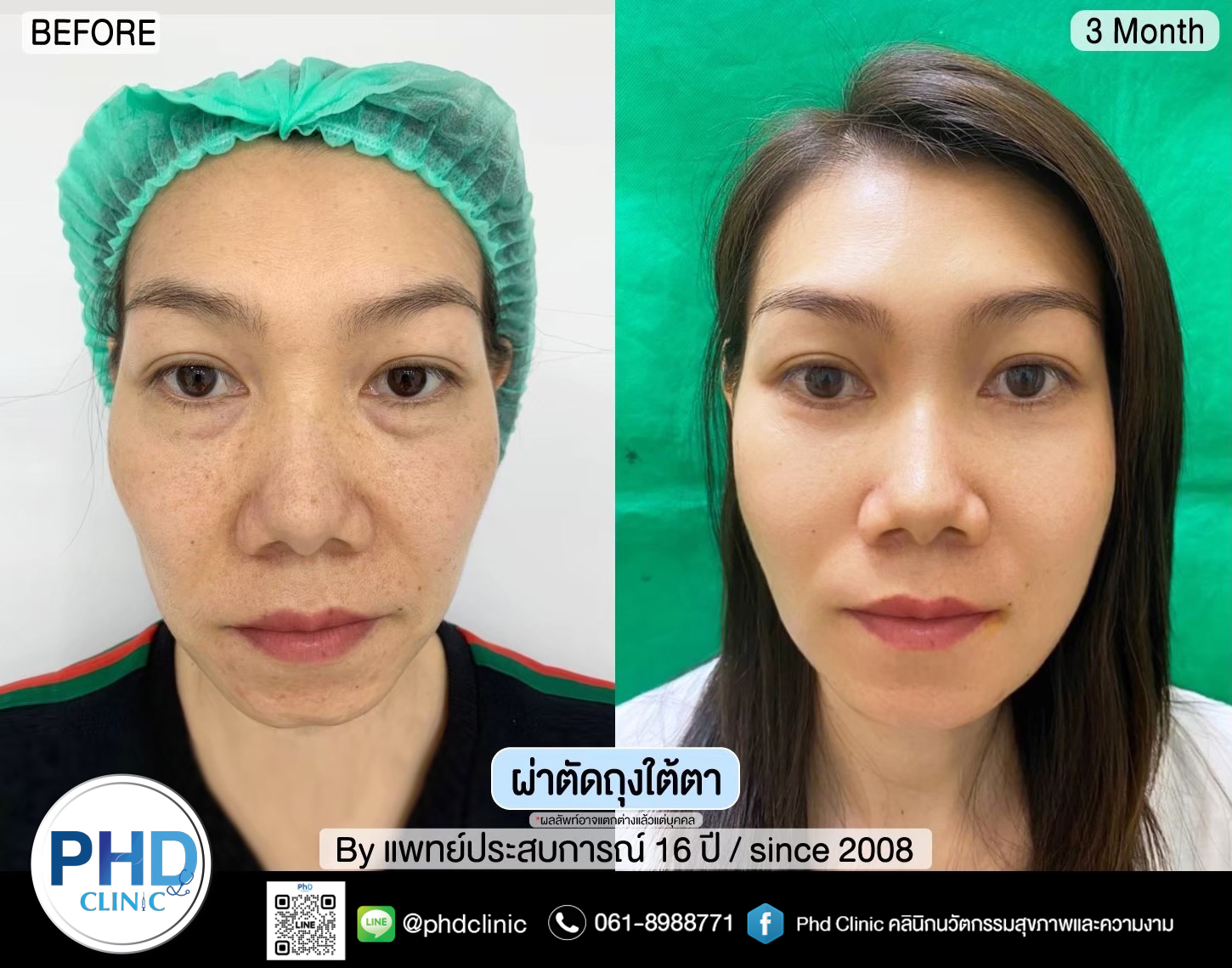 Lower Blepharoplasty