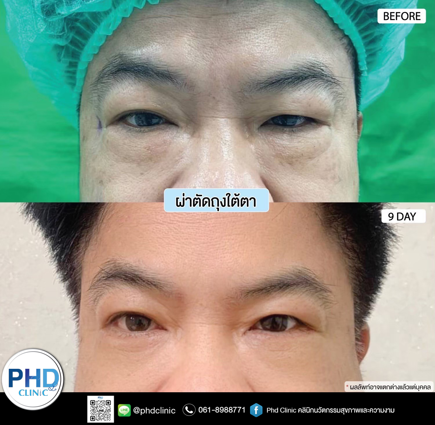 Lower Blepharoplasty