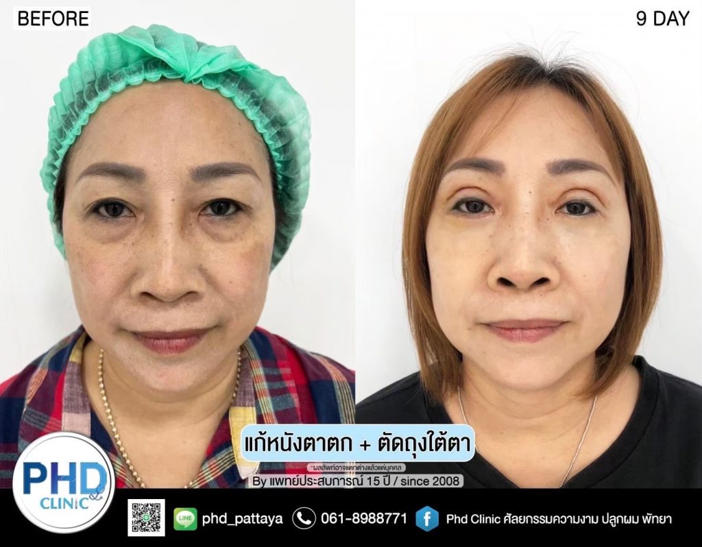 Upper Blepharoplasty