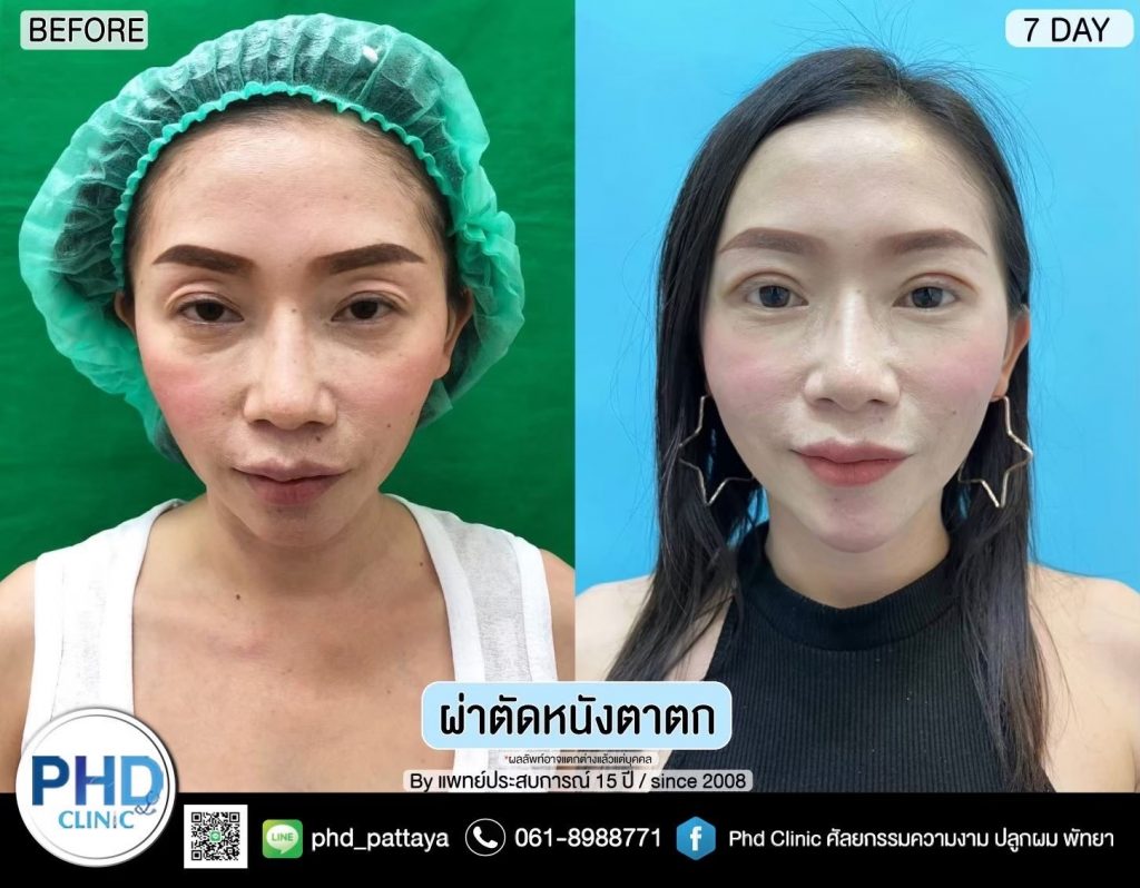 Upper Blepharoplasty