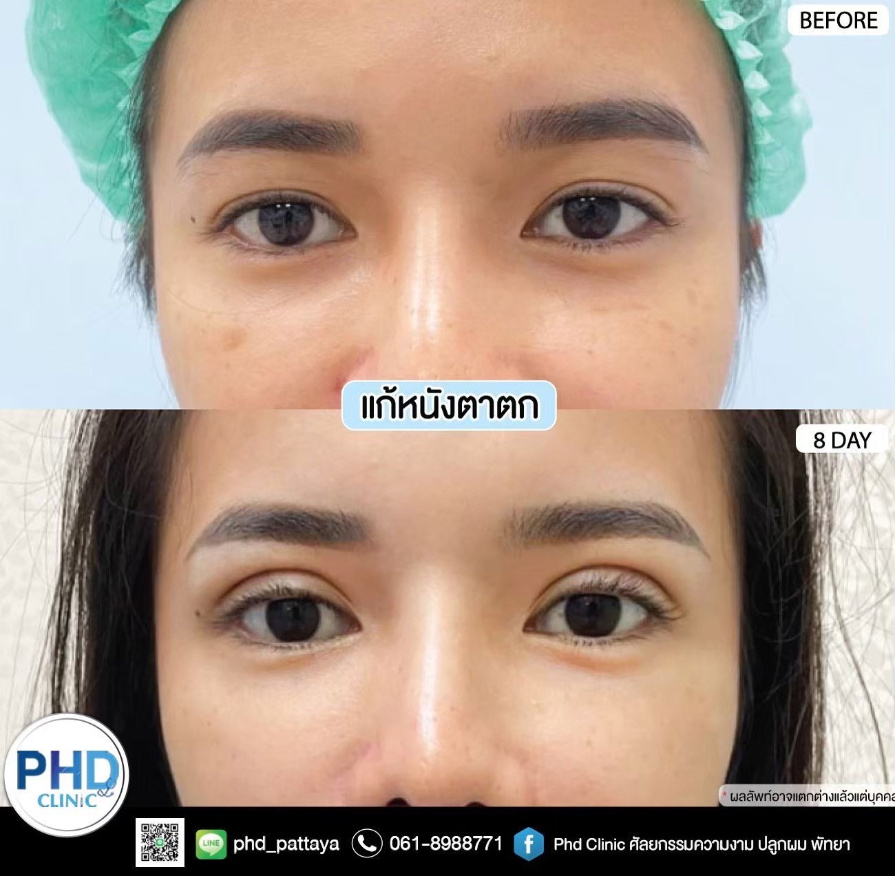 Upper Blepharoplasty