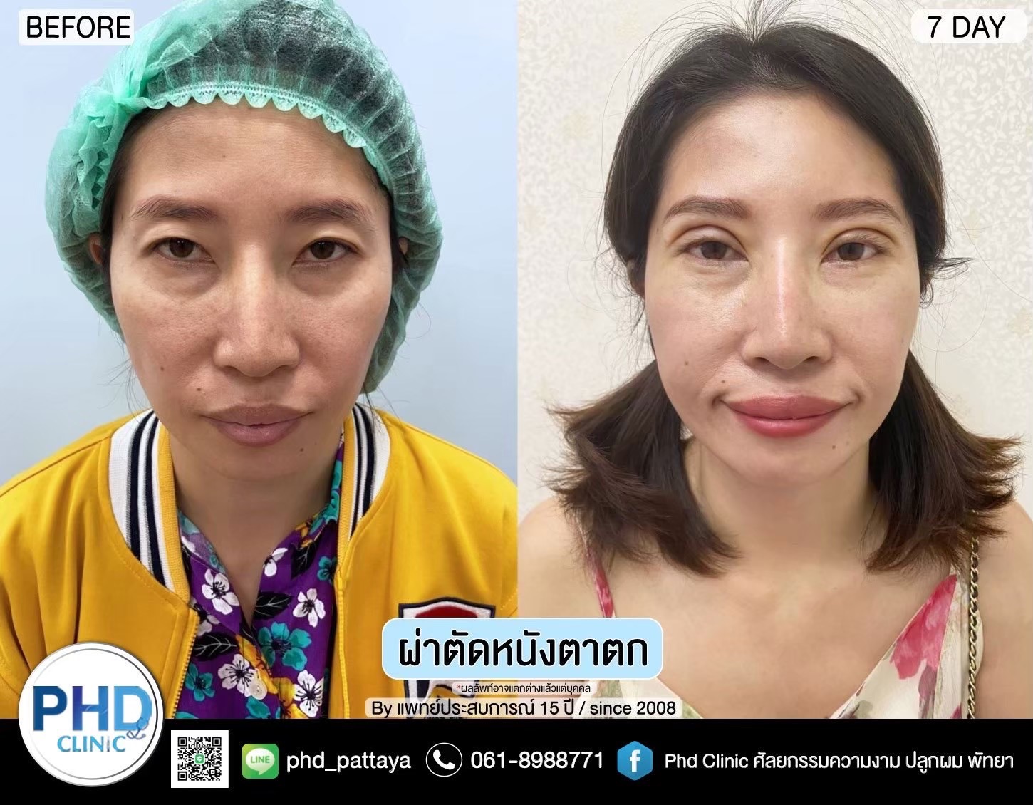 Upper Blepharoplasty