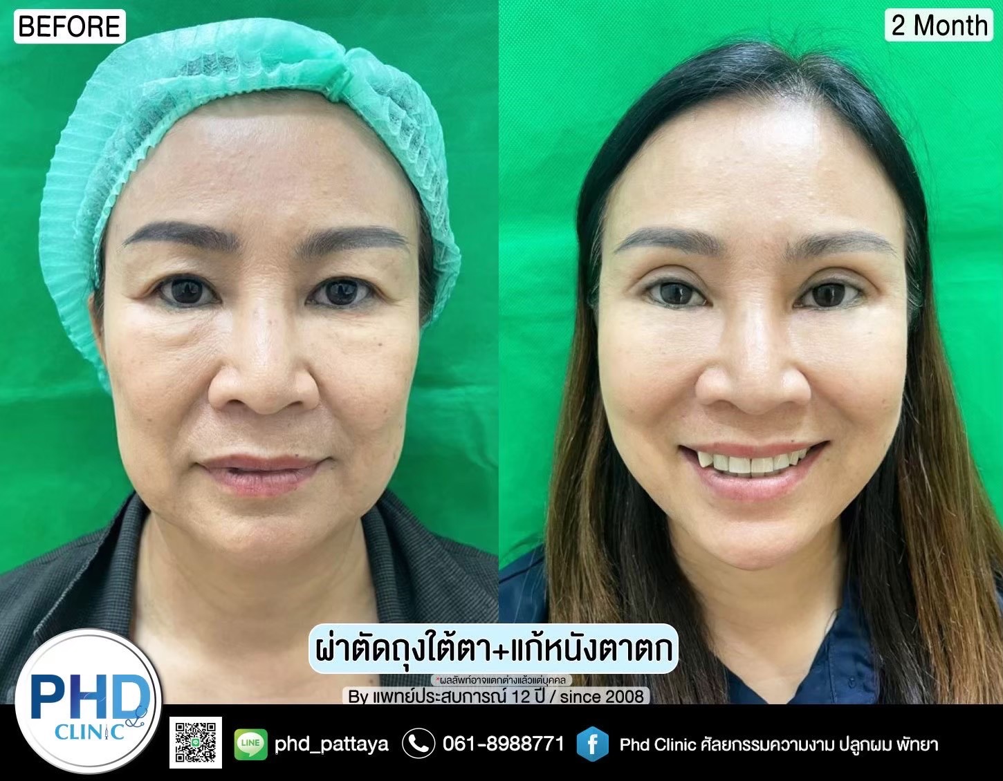 Upper Blepharoplasty