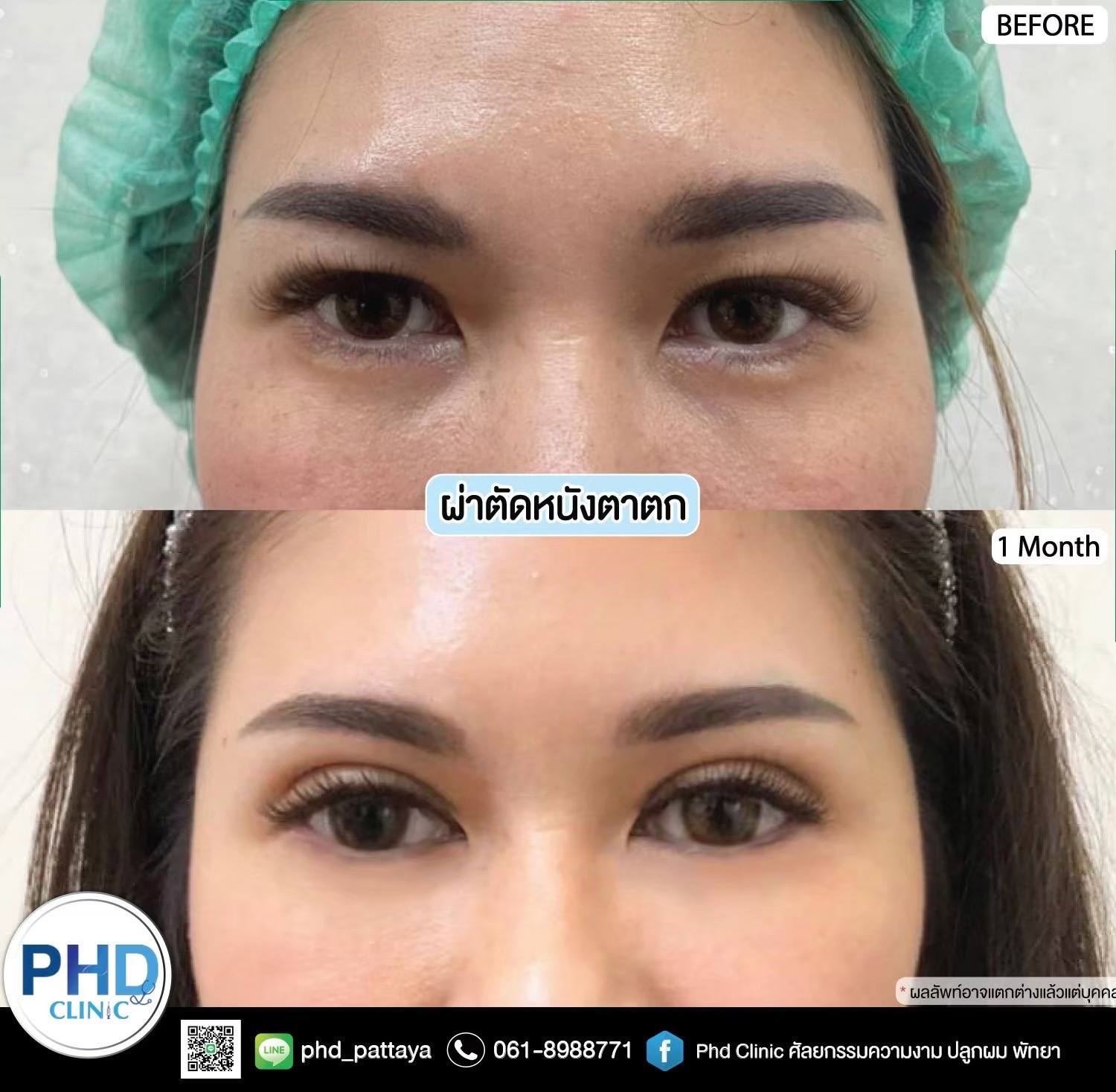 Upper Blepharoplasty