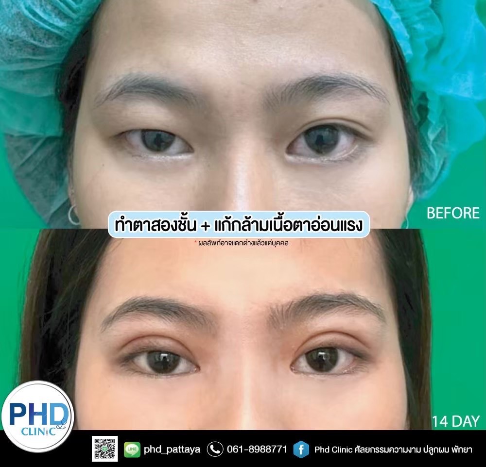 Upper Blepharoplasty