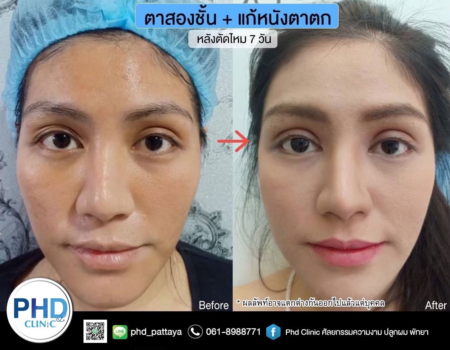 Upper Blepharoplasty