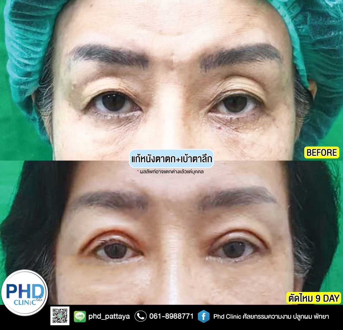 Upper Blepharoplasty