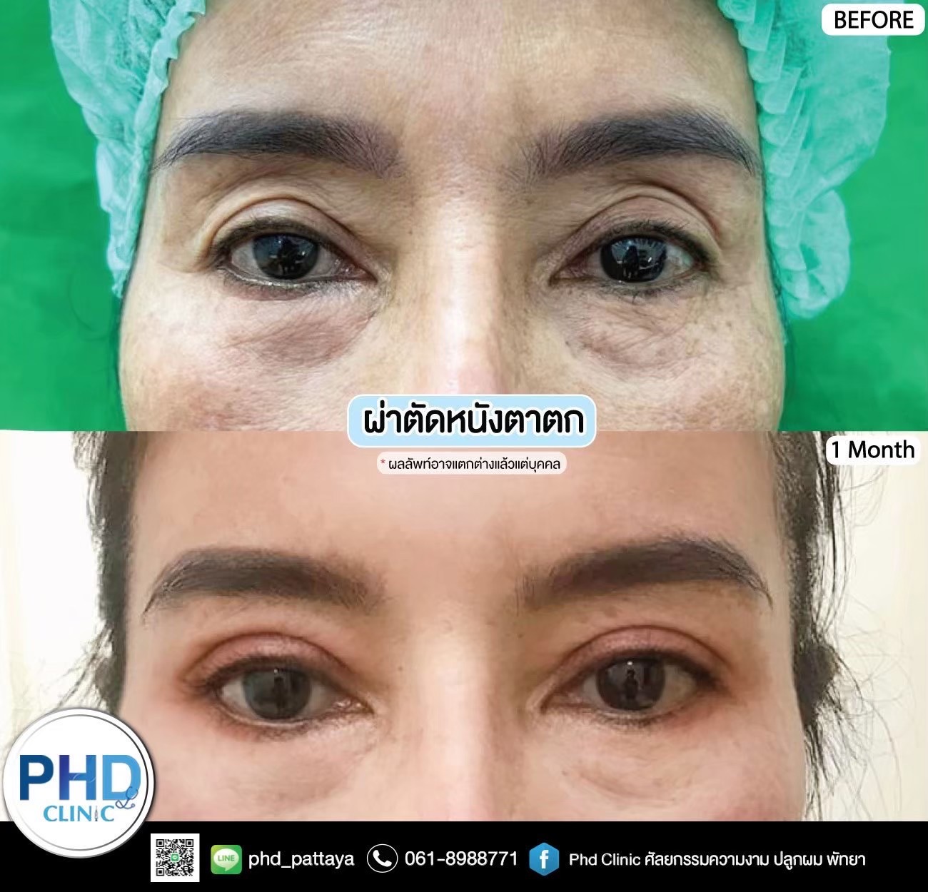 Upper Blepharoplasty