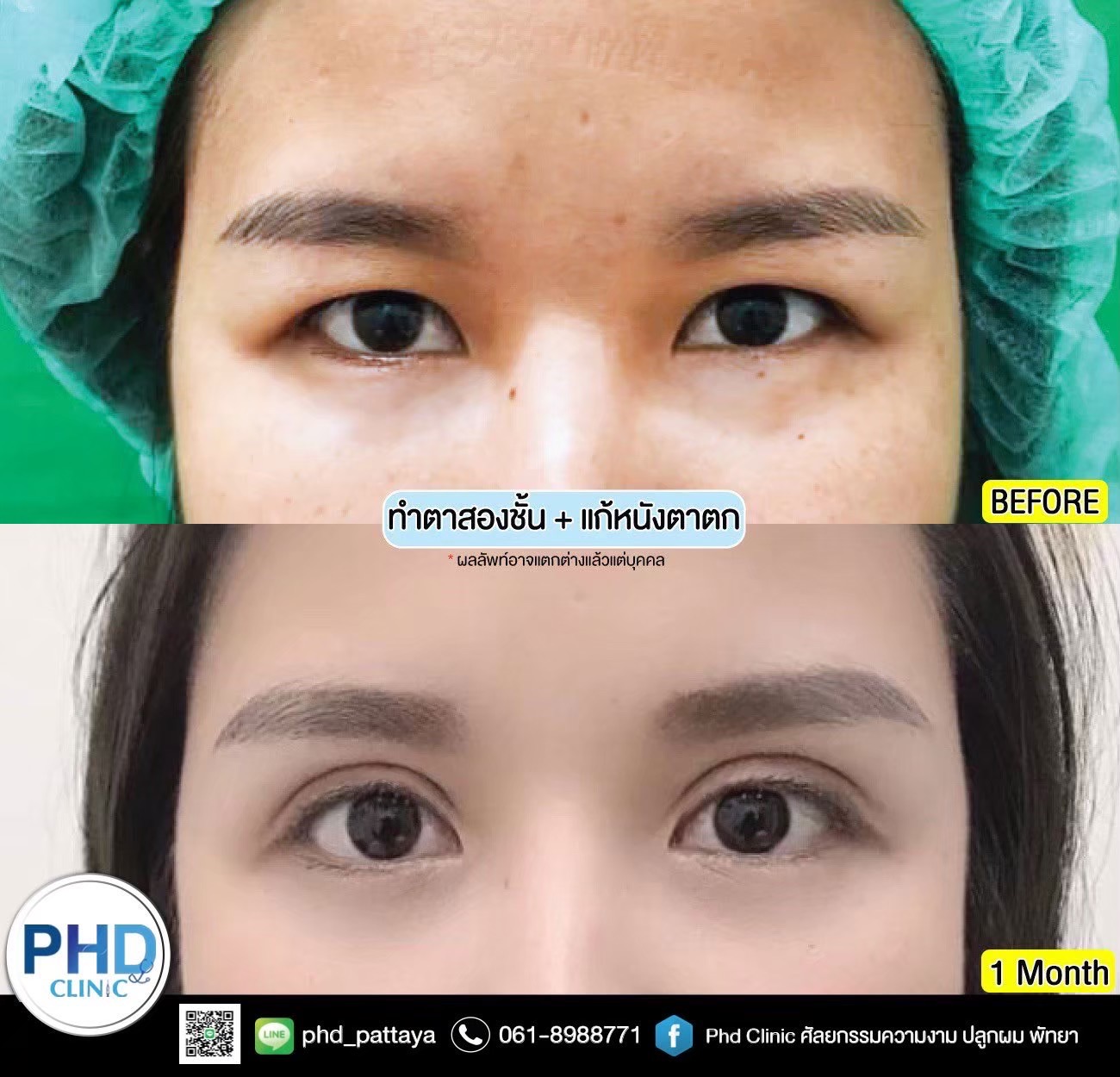 Upper Blepharoplasty