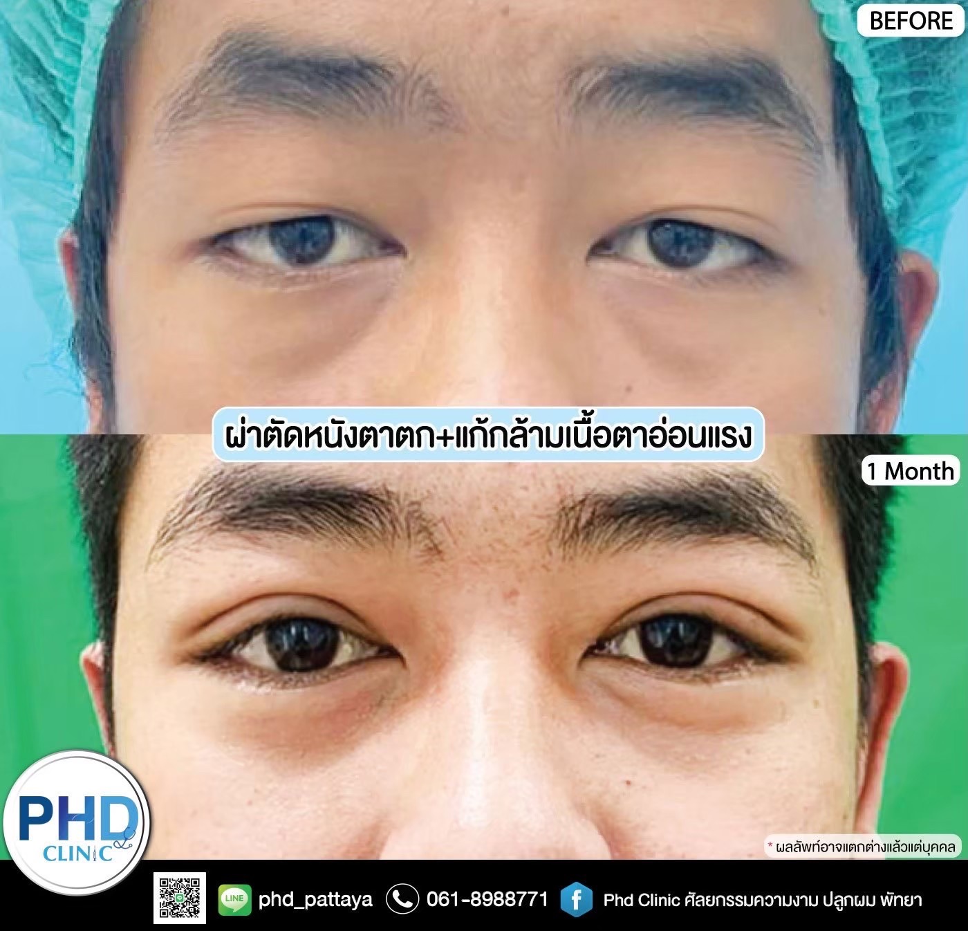 Upper Blepharoplasty