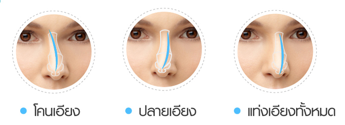 Revision Rhinoplasty