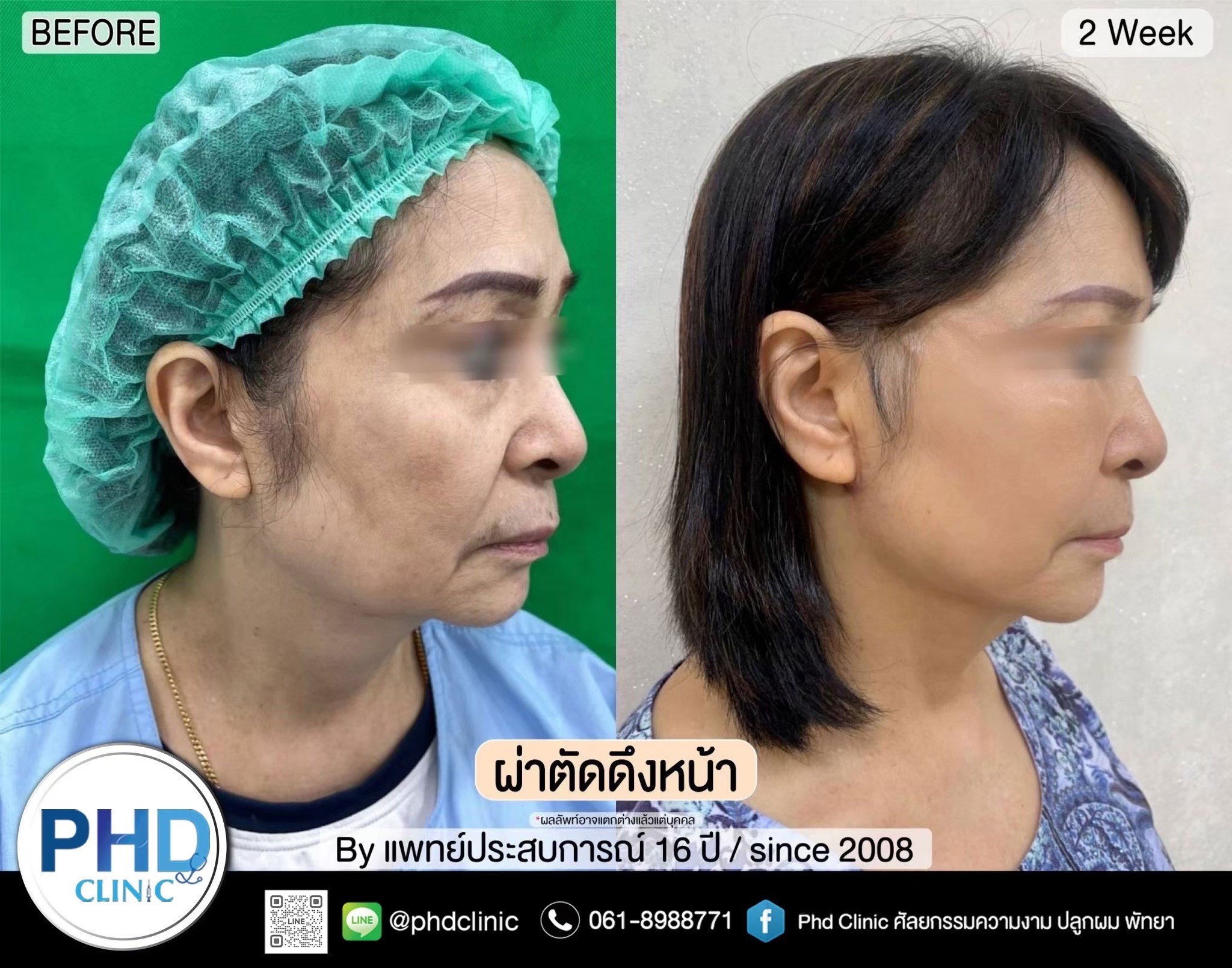 Rhytidectomy Pattaya