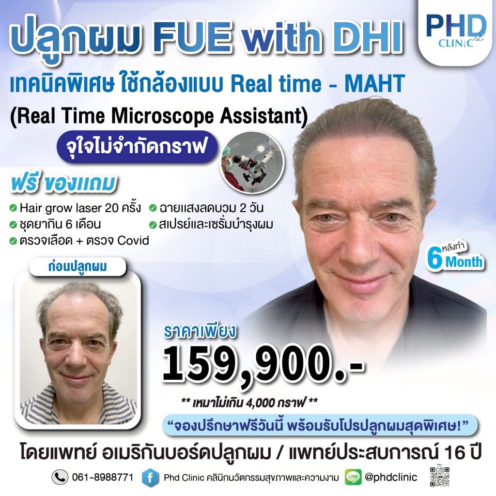 ปลูกผม