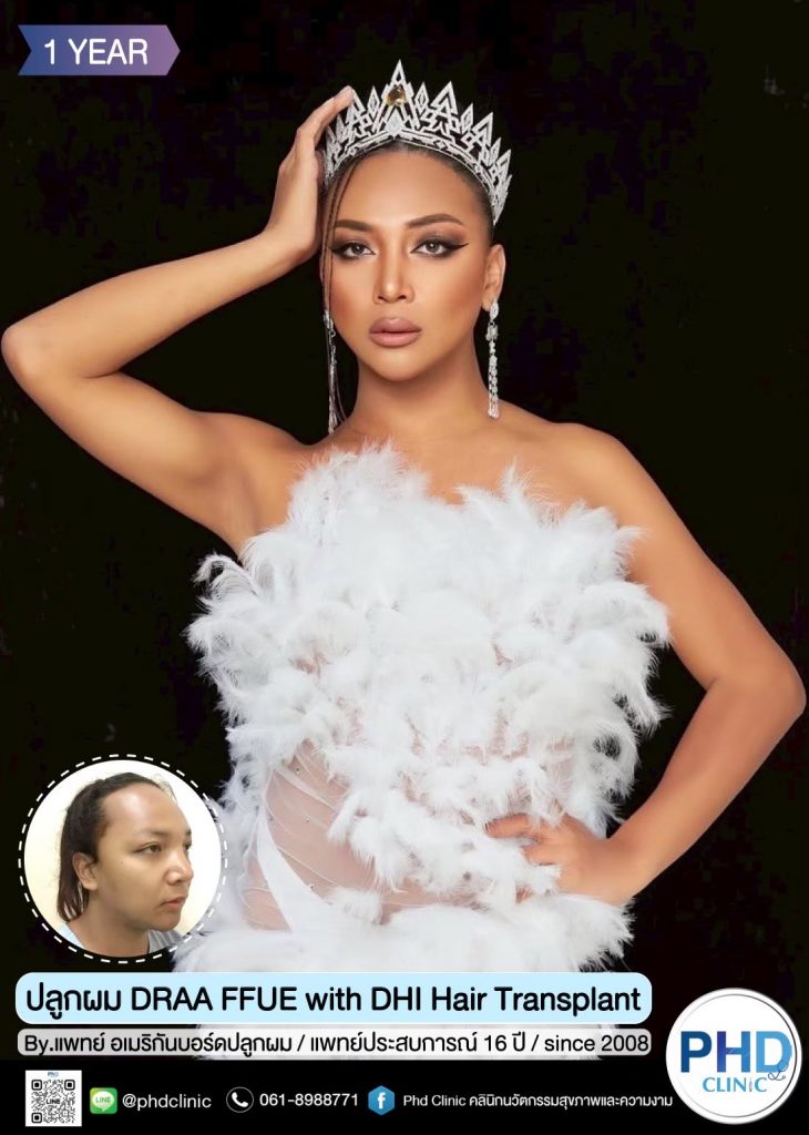 ปลูกผมภูเก็ต