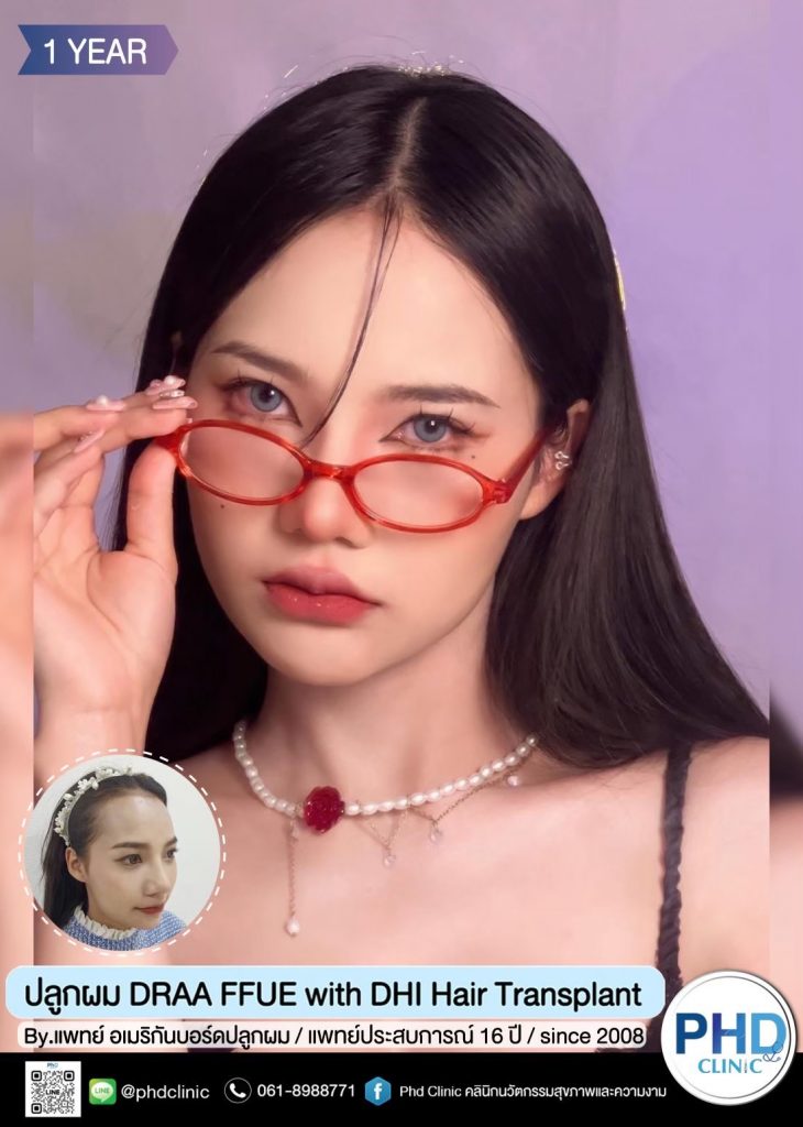 ปลูกผมภูเก็ต