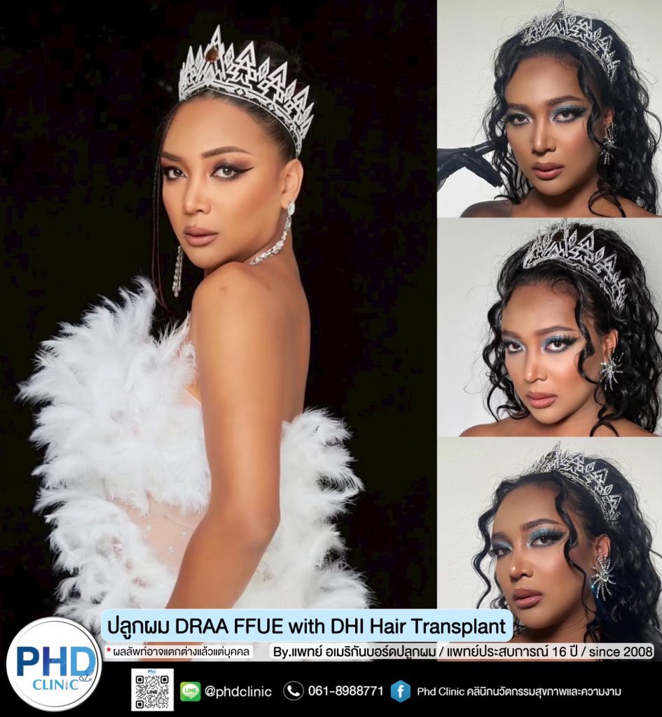 ปลูกผมภูเก็ต