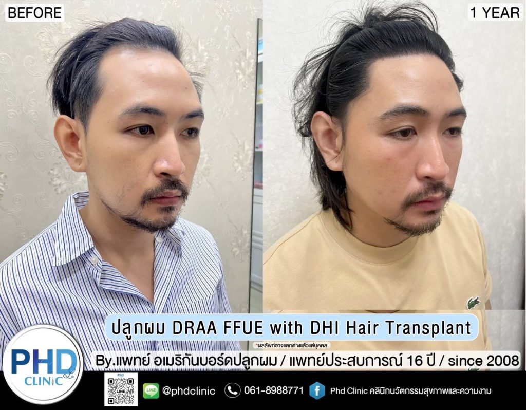 ปลูกผมภูเก็ต