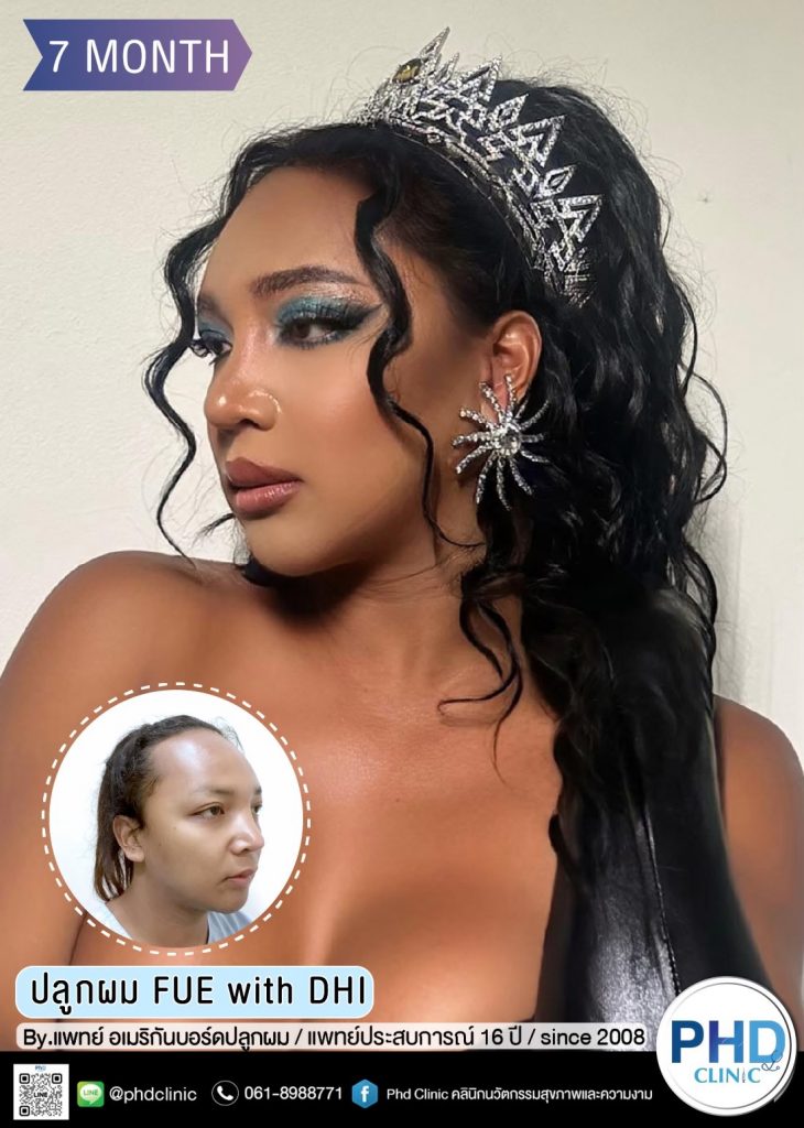 ปลูกผมภูเก็ต