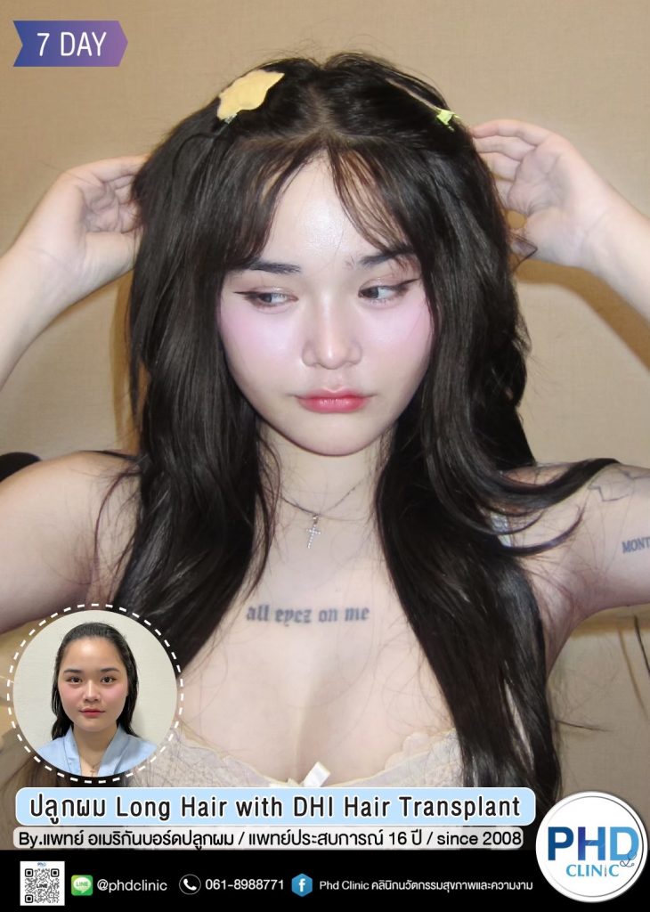 ปลูกผมภูเก็ต