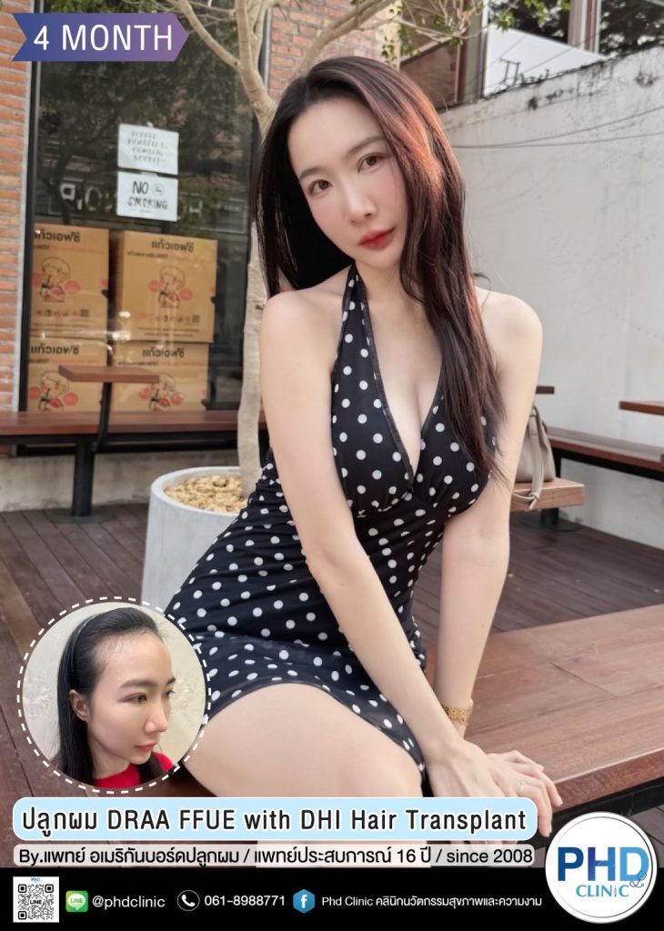 ปลูกผมภูเก็ต