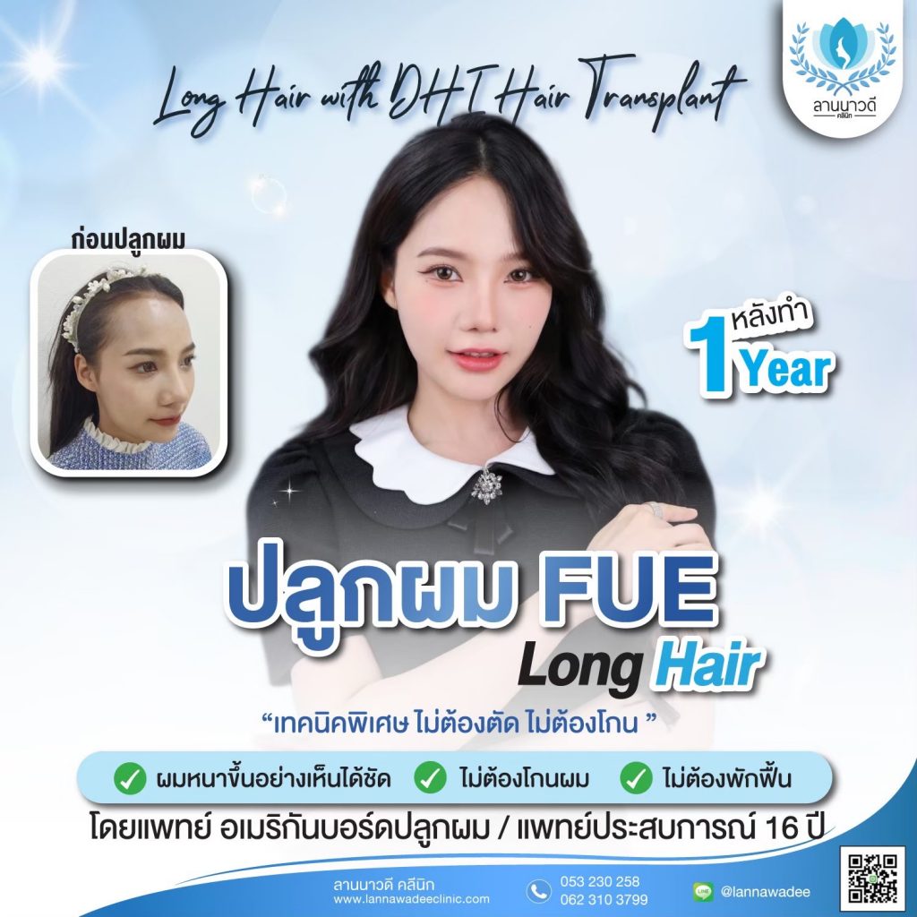 Long Hair Transplant