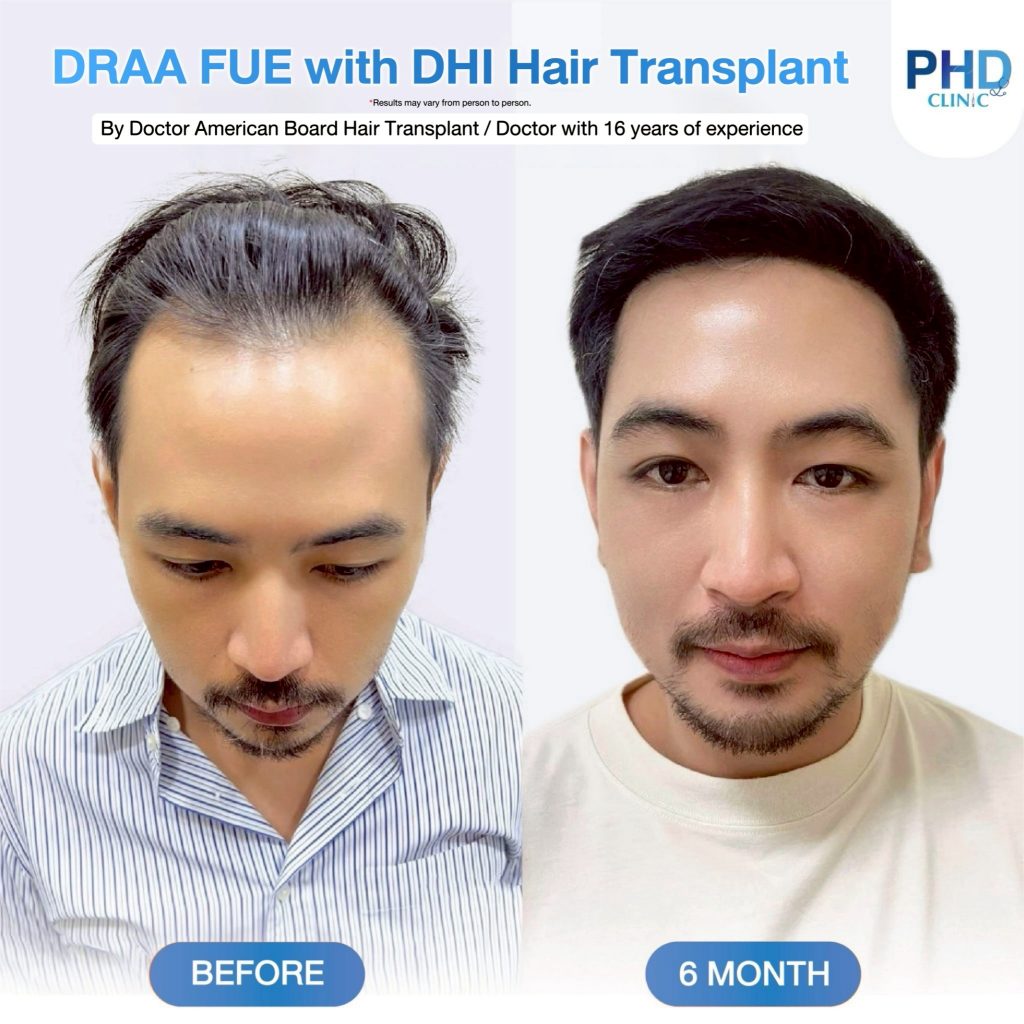 Frontal hairline transplant