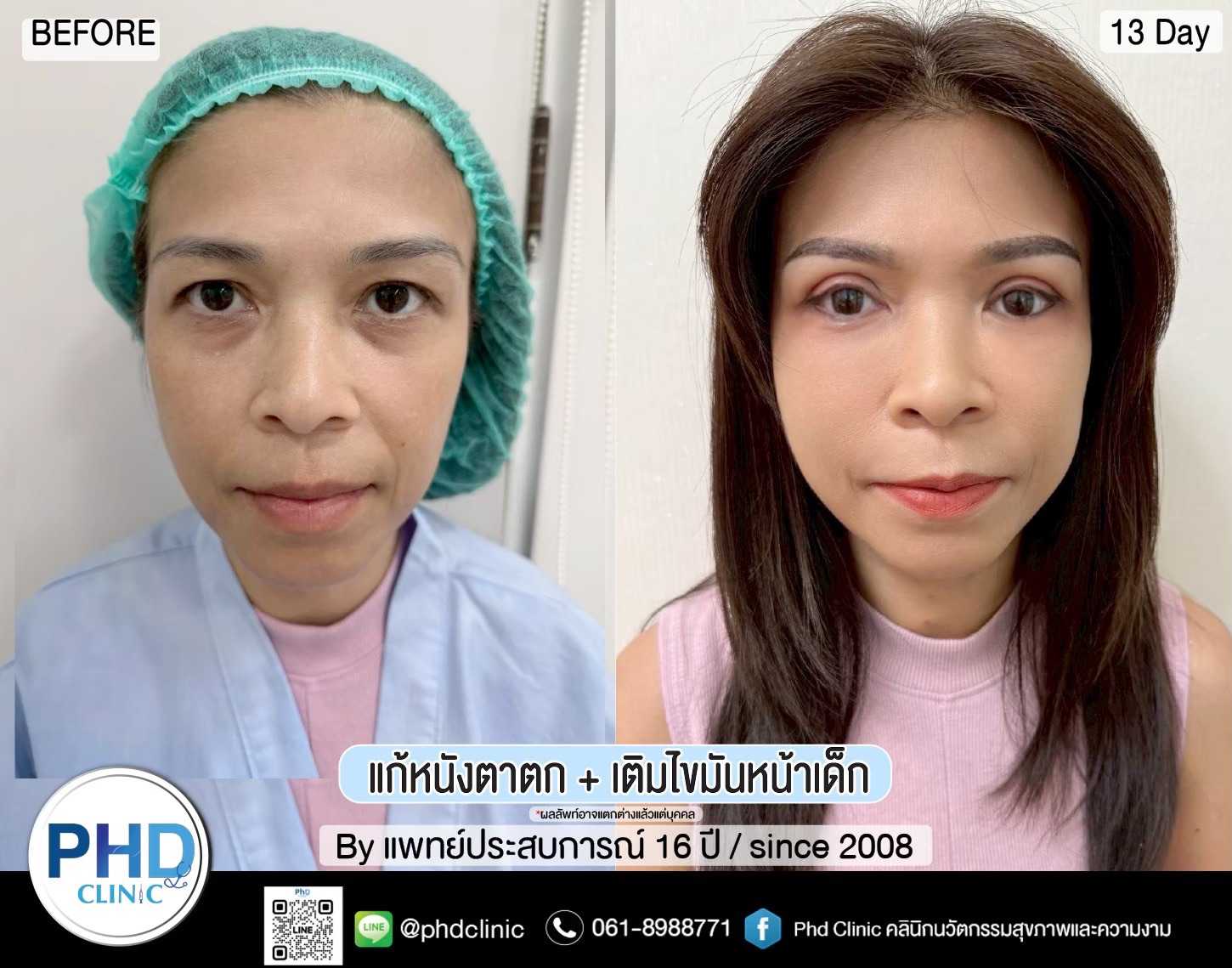 ฉีดไขมันหน้าพัทยา