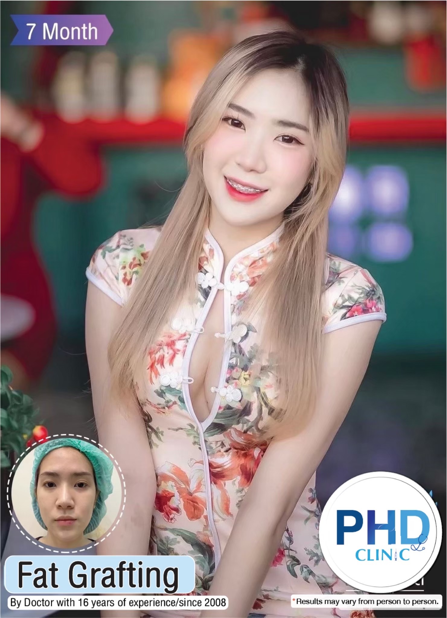 เติมไขมัน