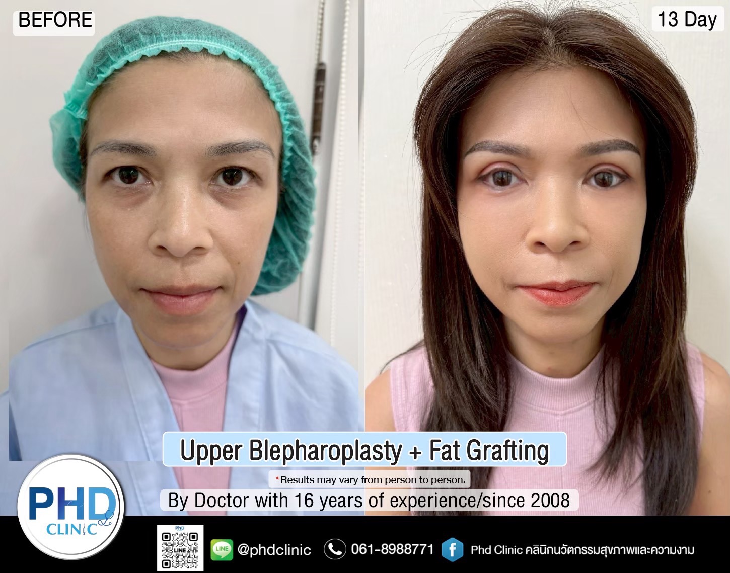 Fat Grafting Phuket Fat Grafting Phuket