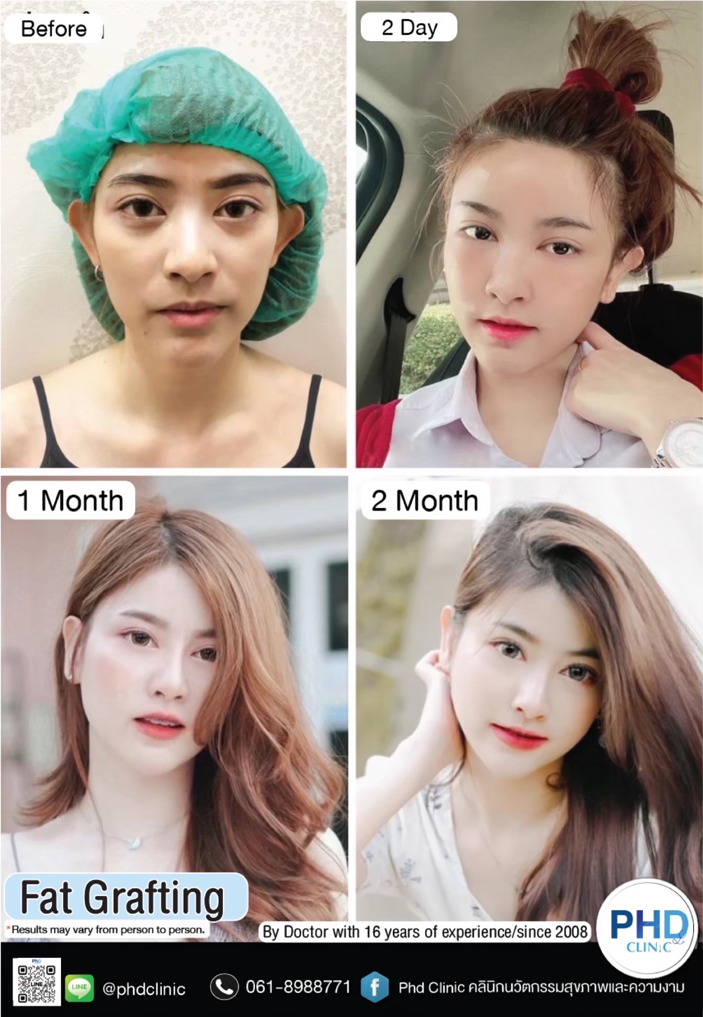 Fat Grafting Phuket