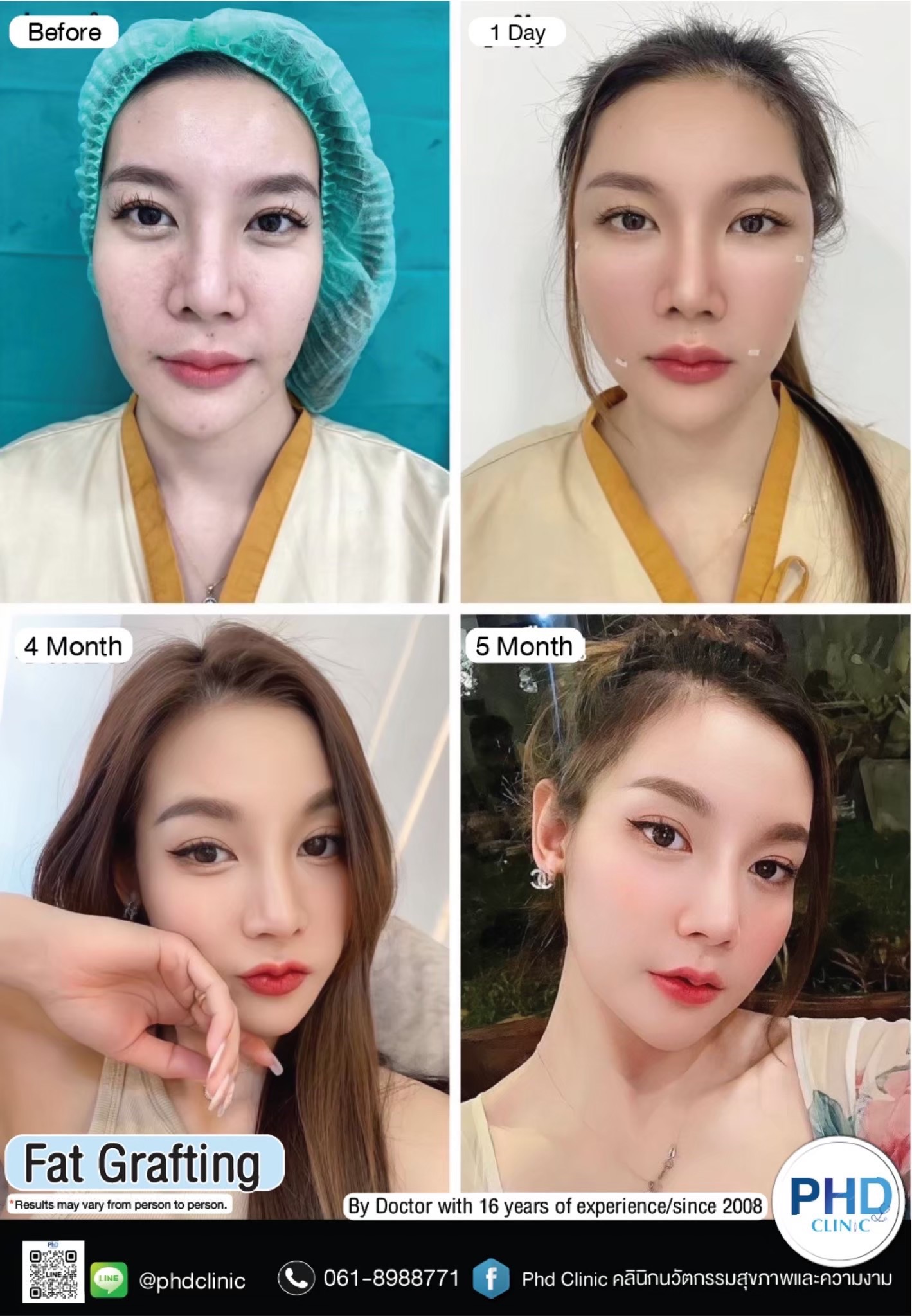 Fat Grafting Phuket