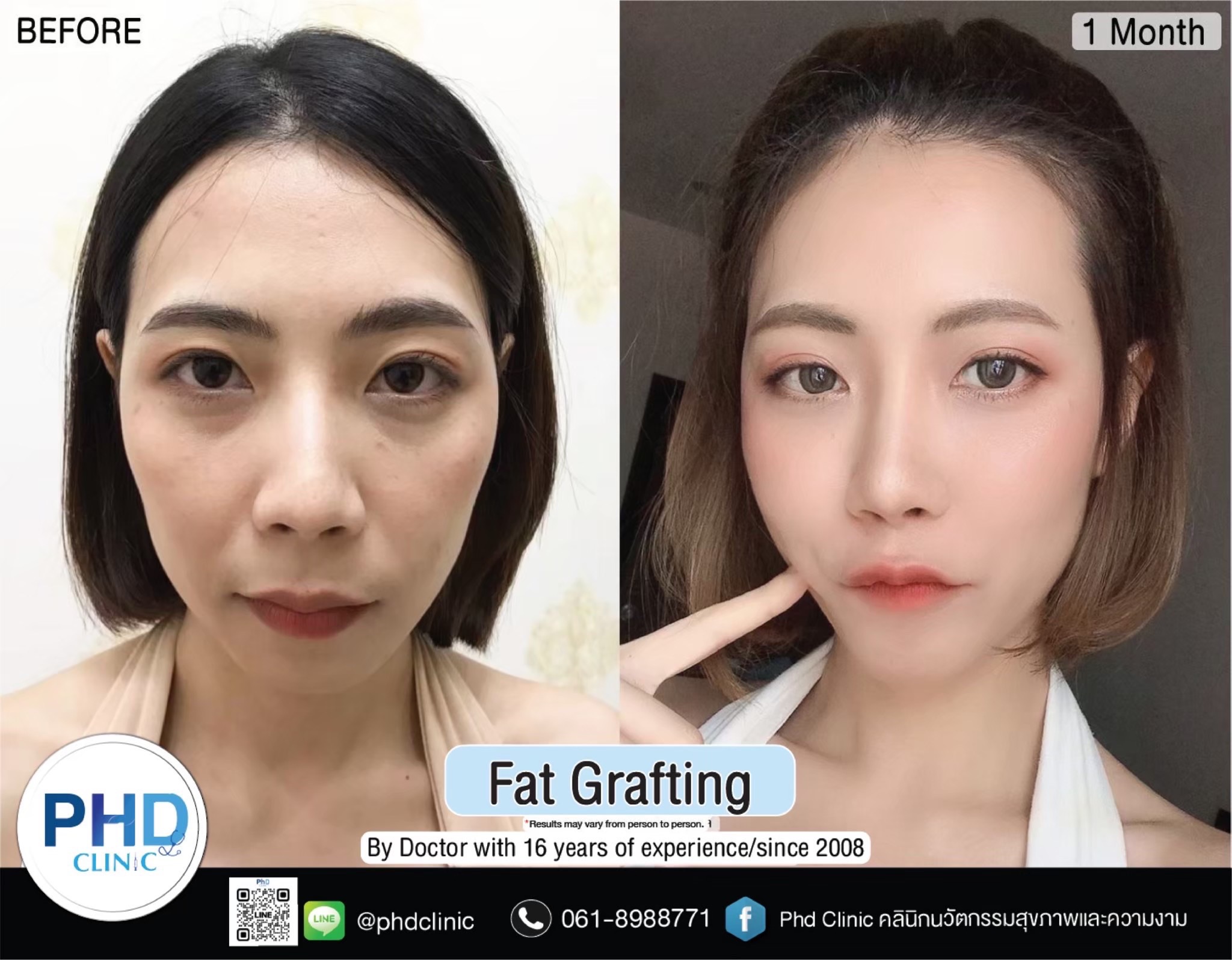 Fat Grafting Phuket